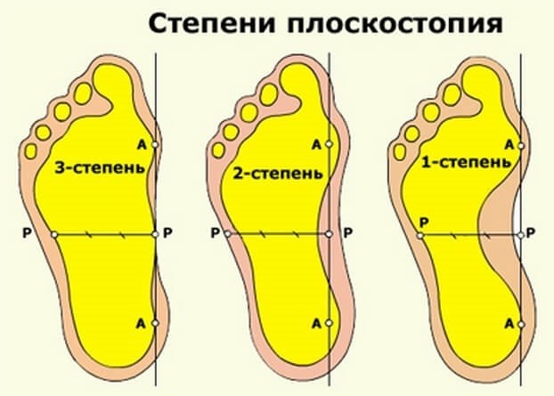 Плоскостопие и военные в 2025 году